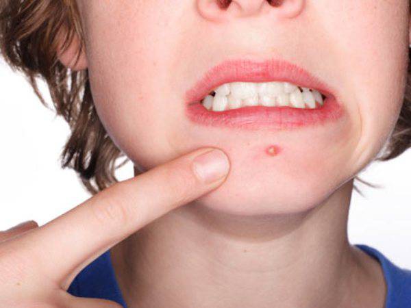 Causes and Symptoms Of Acne
