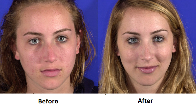 Bring About A Marked Improvement In Your Looks With Ethnic Rhinoplasty