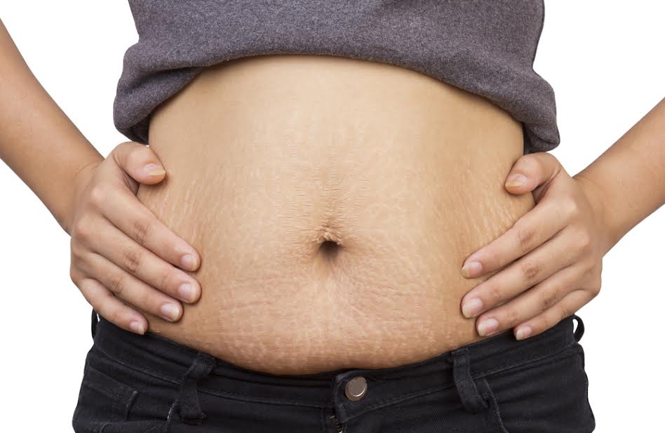 How To Minimize Stretch Marks During Growth Spurts