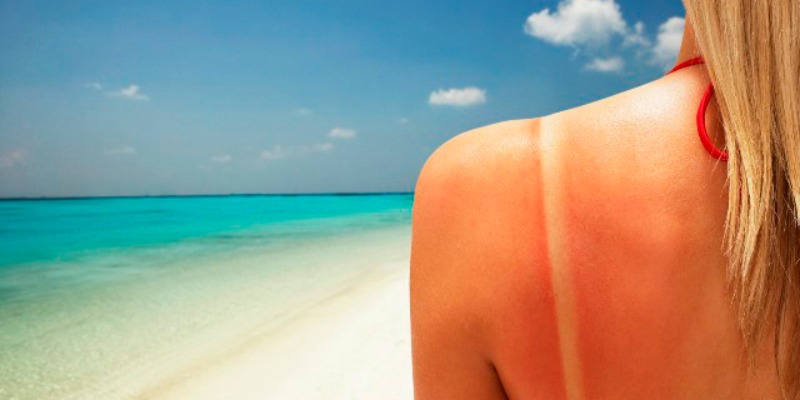 Remedies For Sunburn