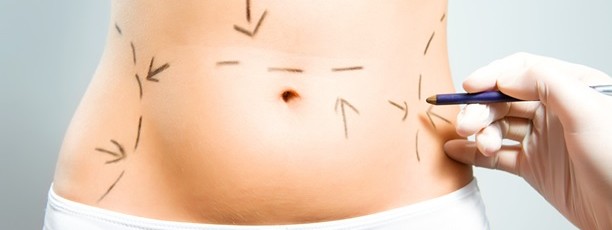 The Liposuction Surgery - What To Expect From This Procedure
