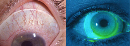 Why Are Scleral Lenses A Better Option Than Contact Lenses?