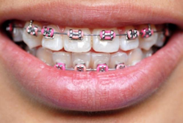 How To Deal With Your Child's Worries About Braces
