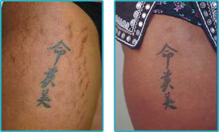 Laser Tattoo Removal Clinic - Choose One Wisely