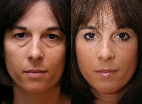 Eyelid Surgeon Can Perform Amazing Things To Your Face