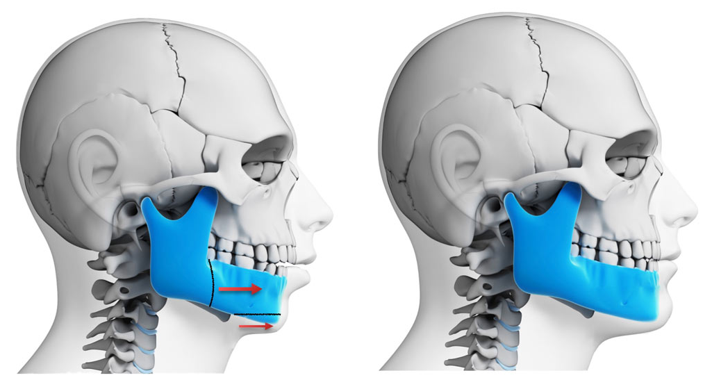 Different Benefits And Effects Of Jaw Surgery