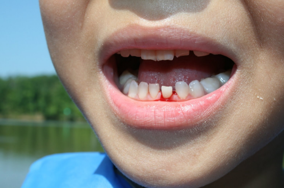 What's Behind A Wobbly ‘Loose’ Tooth?