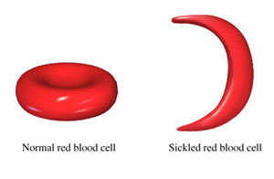 Understanding The Complications Of Sickle Cell Disease
