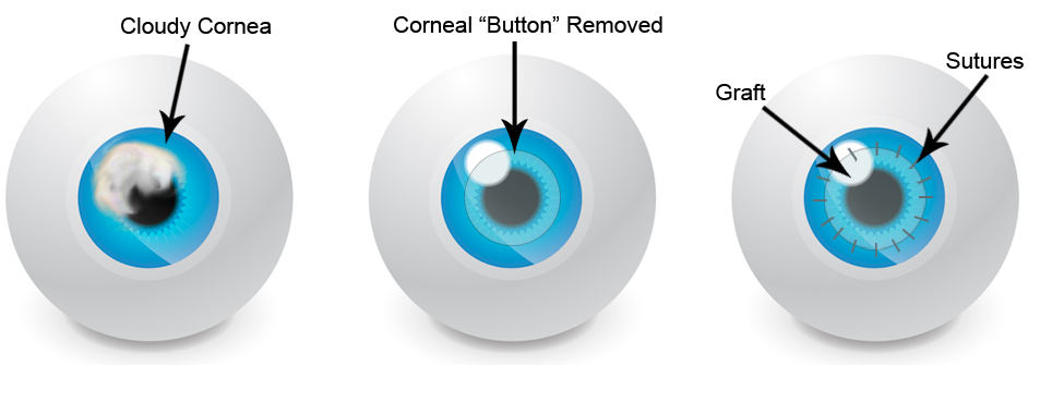 Corneal Transplant