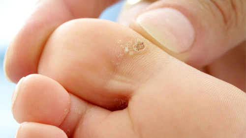 Everything You Should Know From What Are Warts And How To Get Rid Of Them