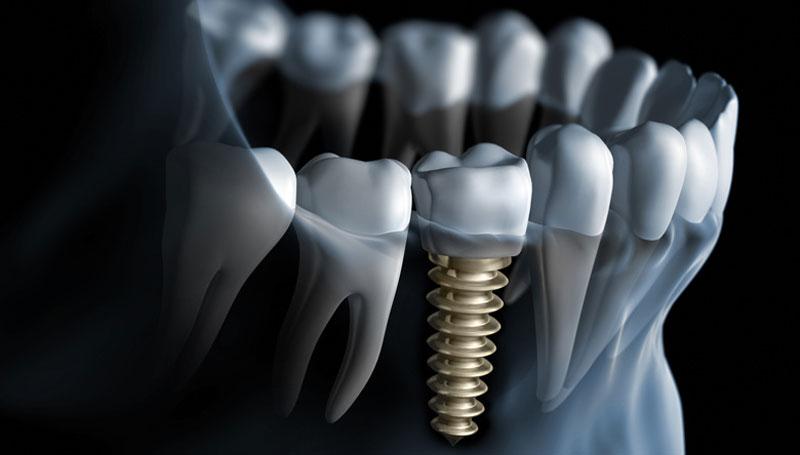 Different Types Of Dental Implants and Their Benefits