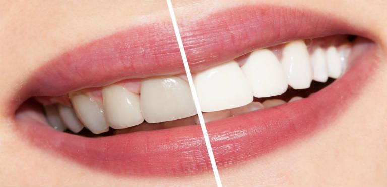 The Need Of Whitening Your Teeth by An Expert Dentist