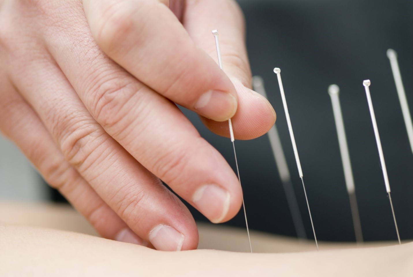 How Acupuncture Works and Why