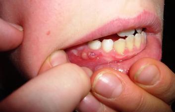 Bleeding Gums- Reason Why They Are Caused