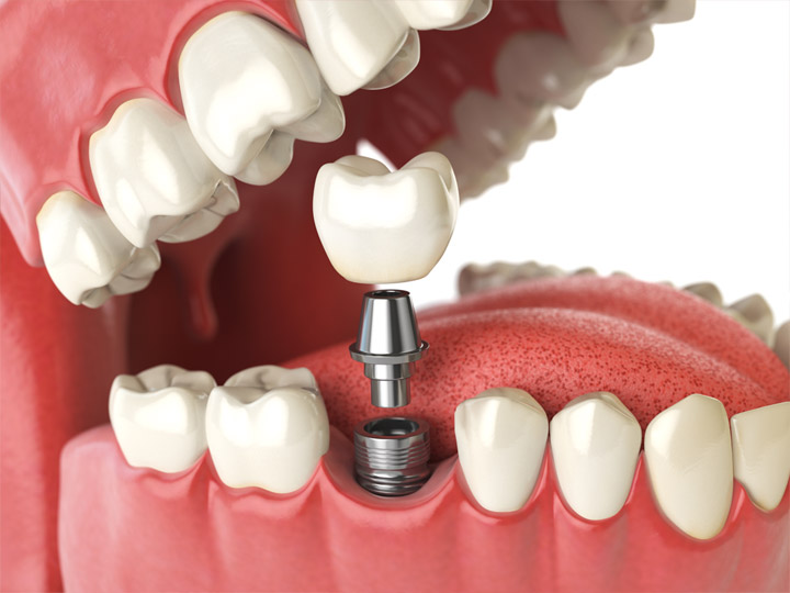 Why Might You Need Dental Implants?