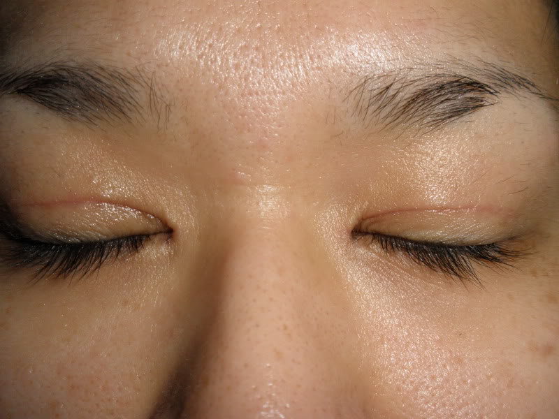 Are Scars Normal After Undergoing An Eyelid Surgery?