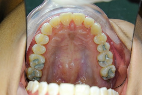 Are Silver Amalgam Implants Safe?