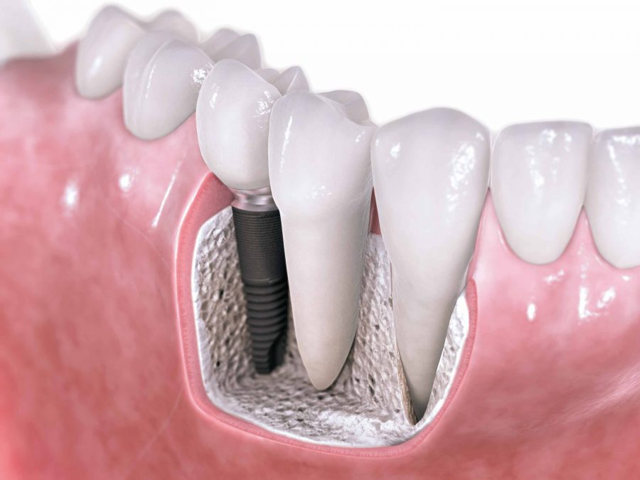 Learn Some Benefits Of Dental Implants