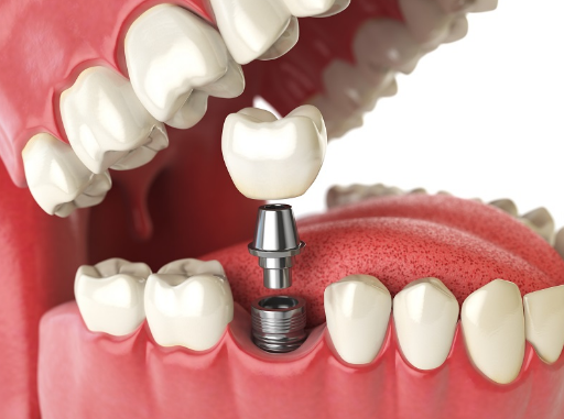Top 5 Ways Dental Implants Can Enhance Your Smile