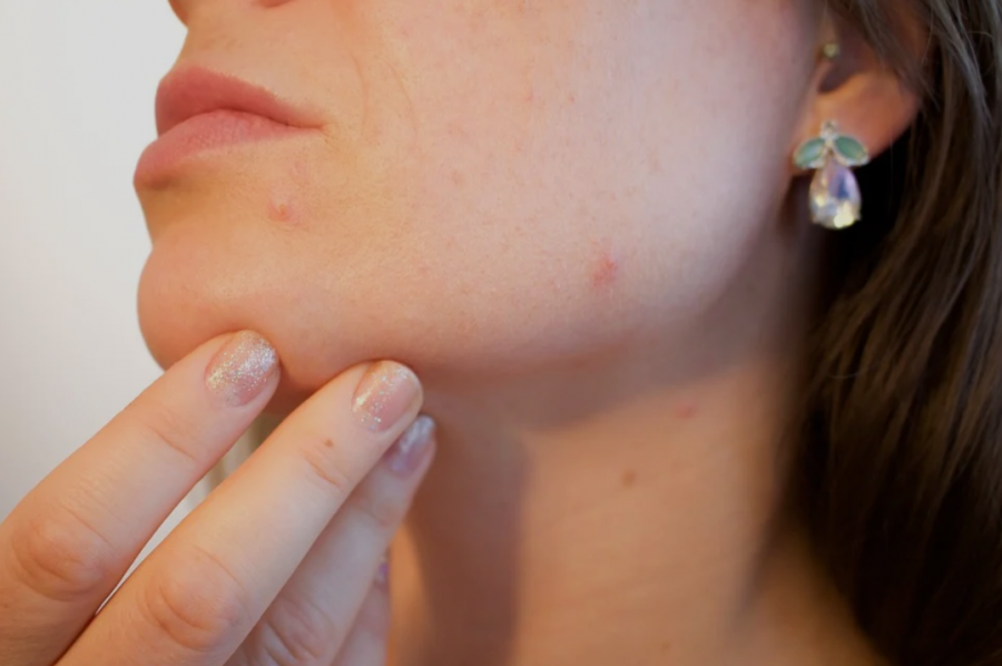 What Is Your Skin Trying to Tell You When Your Face Breaks Out With Acne?