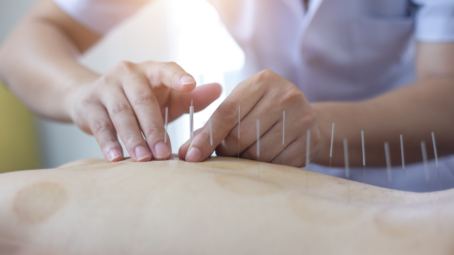 Top 5 Questions About Acupuncture To Ask Your Doctor