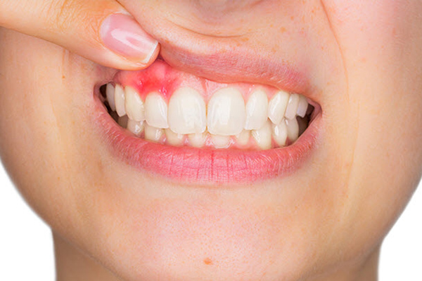 5 Easy Ways To Improve Gum Health