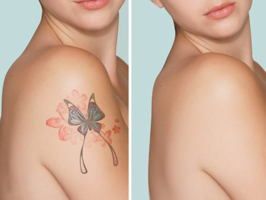 What You Need To Know Before Going For Tattoo Removal